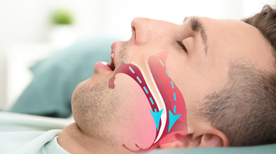 SAĞLIKSIZ BESLENME UYKU APNESİNE DE DAVETİYE ÇIKARIYOR